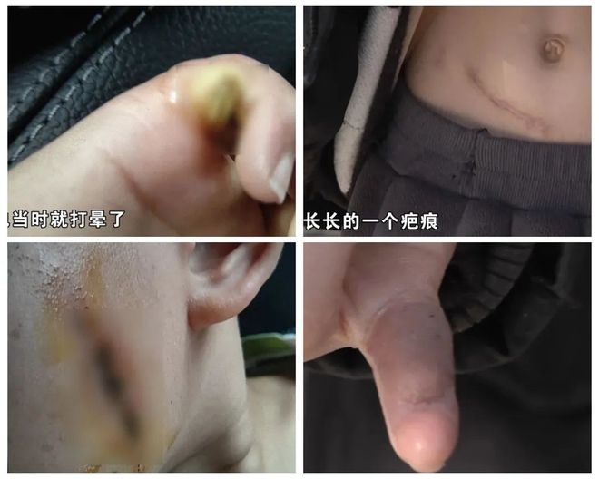 岁儿童爬空调外机瞬间晕厥！米乐m6肌腱都打断了！5(图7)